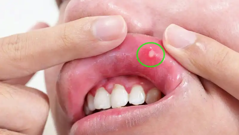 Vücudunuzun B Vitamini Eksikliği Çeken Gizli Belirtileri