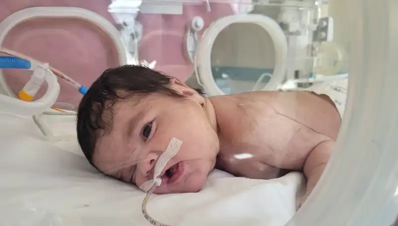 Dünyada Eşine Az Rastlanan Olay: 34 Haftalık Eymen Bebek Doğdu